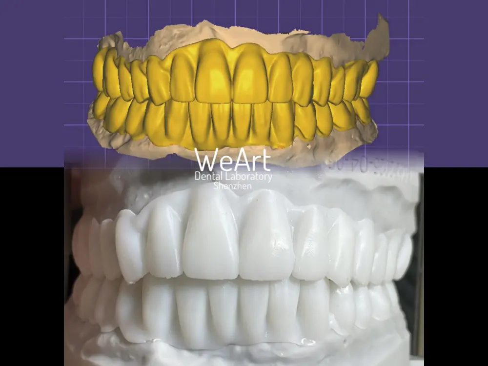 Temporary Crown